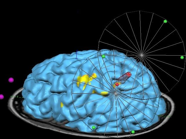 Forschende stimulieren spezifische Bereiche der Gehirnrinde ©Martin_Lotze