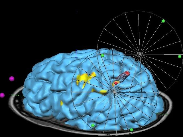 Mittels MRT-navigierter transkranieller Magnetstimulation können nicht-invasiv im individuellen Gehirn des Probanden genaue Bereiche der Gehirnrinde stimuliert werden – Quelle: Prof. Dr. Martin Lotze